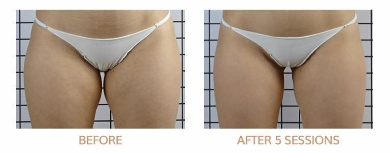 icoone®-binnenbenen-voor-na-5-sessies-beauty-mind.jpg