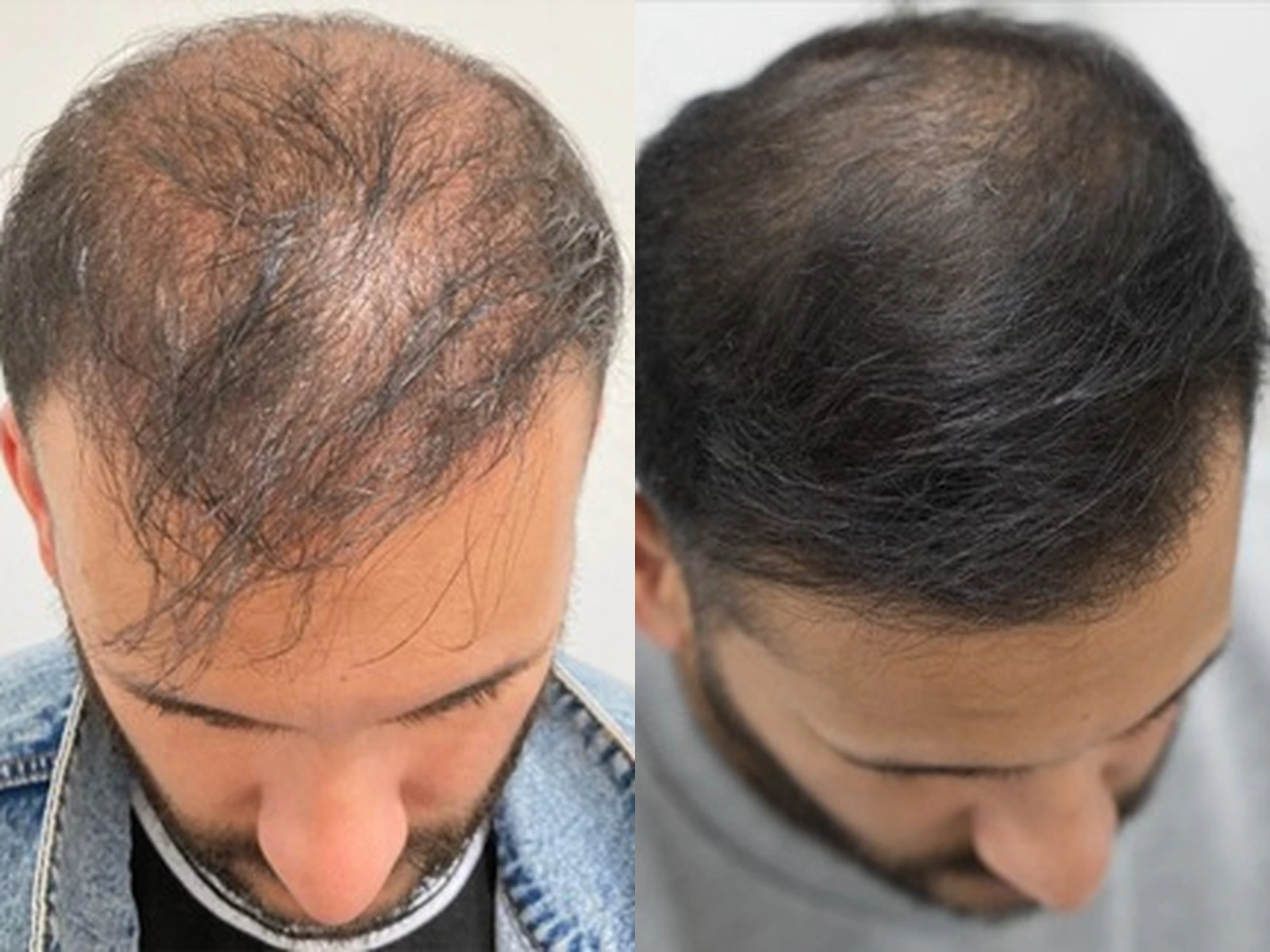 Vergelijking van de haarbedekking boven op het hoofd, met links meer zichtbare hoofdhuid tussen de haren en rechts een voller ogende haarbedekking.