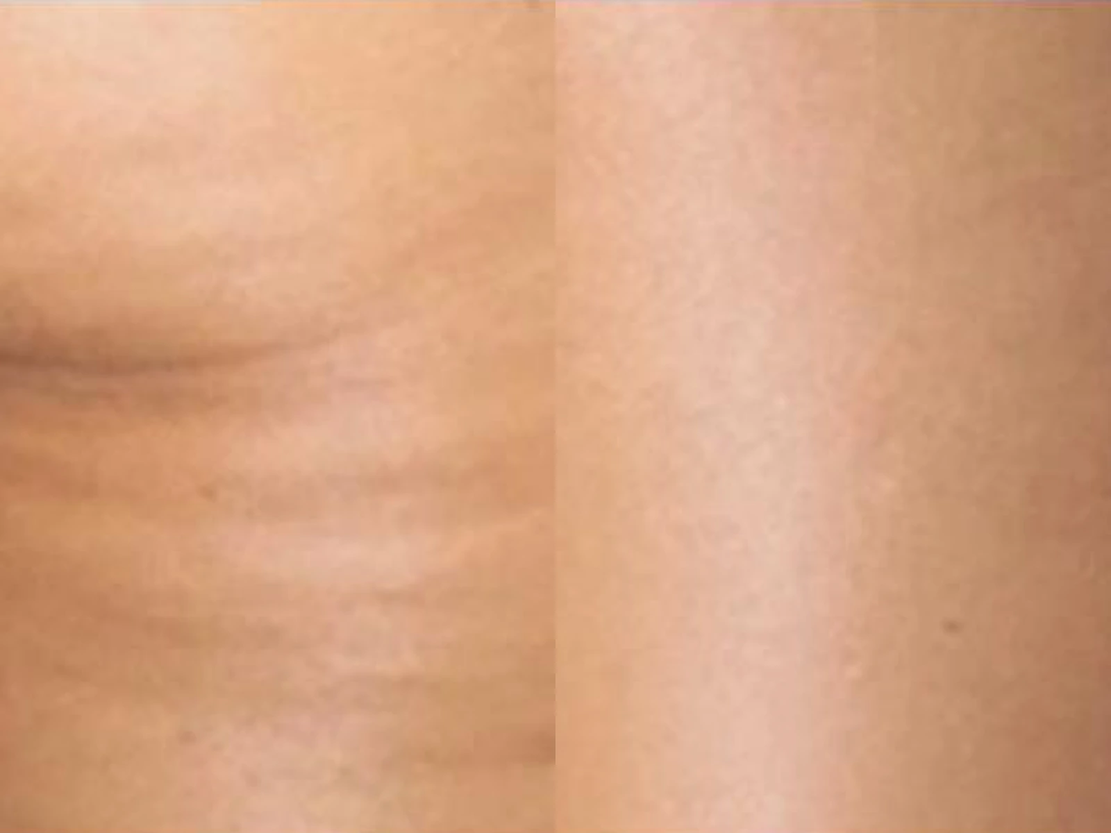 Cellulite op de bovenbenen: links de beginsituatie en rechts de na-opname. Voorbeeld van Beauty & Mind · Endospheres-beeldbank.
