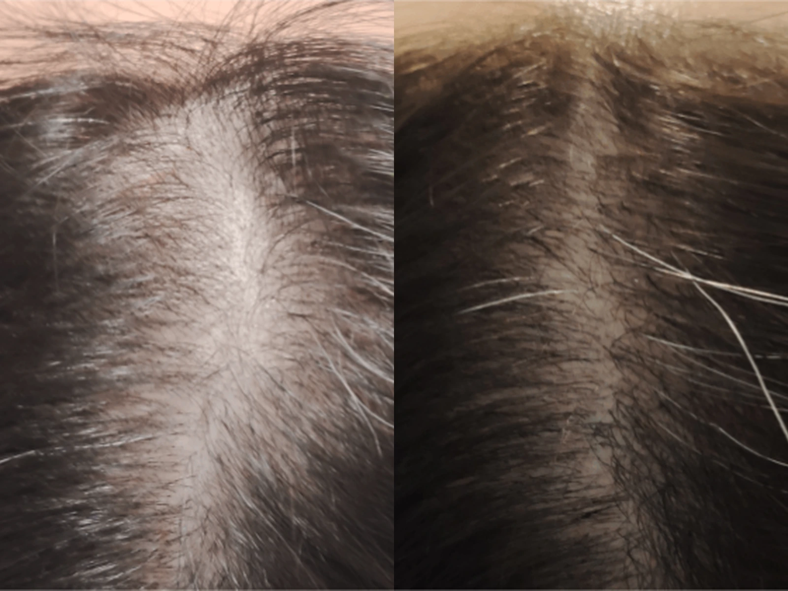 Dunner haar bij de haarlijn en scheiding vóór en na Haargroeistimulatie, met links de beginsituatie en rechts de na-opname.