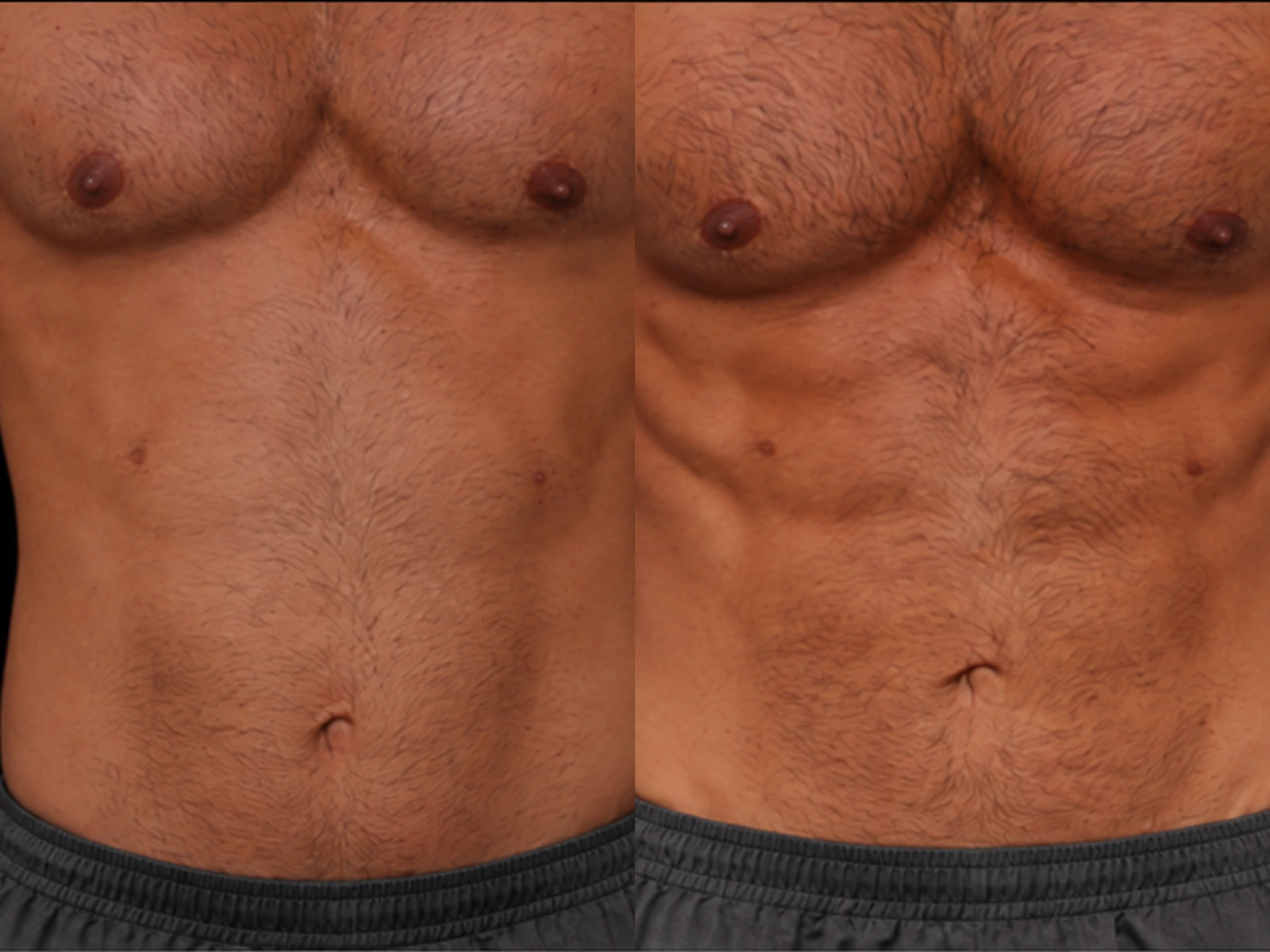Meer definitie in de buikspieren vóór en na HI-EMS Body Sculpting, met links de beginsituatie en rechts de na-opname.
