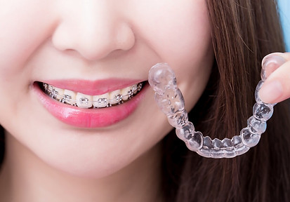 invisaligner 1.jpg