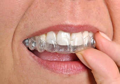 invisaligner 2.jpg