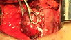 Kidney cancer surgery, specifically, a nephrectomy