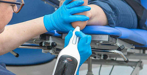 A podiatrist using the handheld Swift Pro device to treat a verruca.