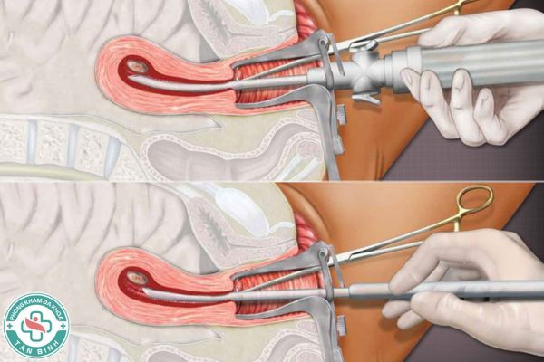 Ưu điểm của phương pháp nong gắp thai – Được chứng nhận bởi bác sĩ