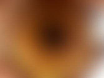 Laser Peripheral Iridotomy