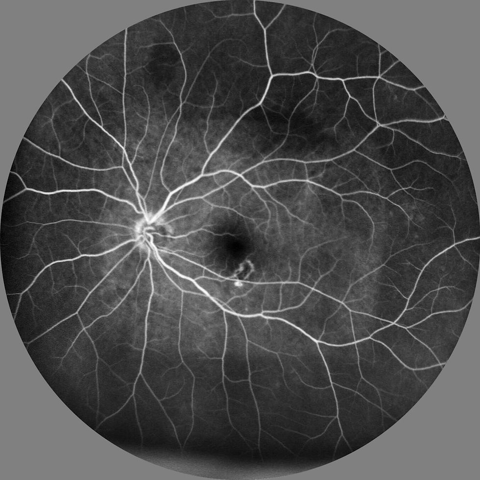 Fundus Fluorescein Angiography / Indo-Cyan Green Angiography