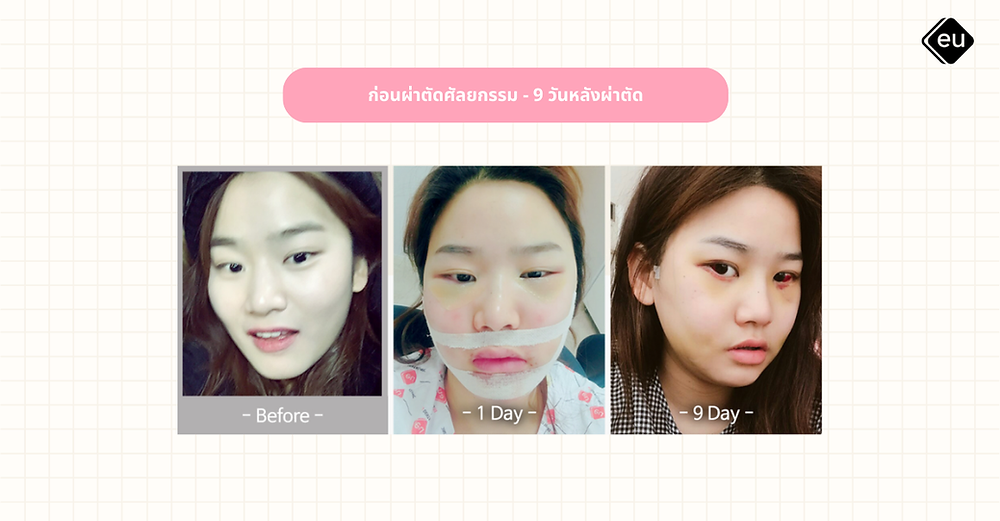 ภาพรีวิวหลังผ่าตัดศัลยกรรม