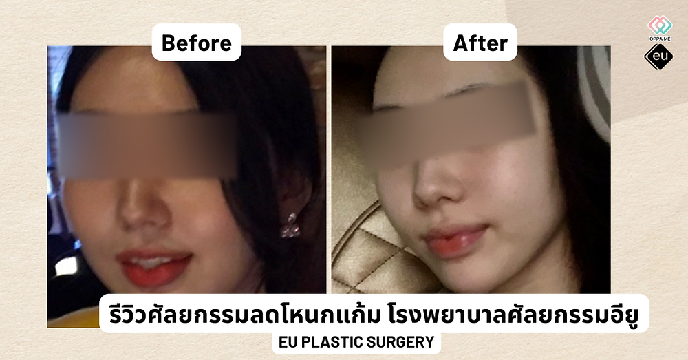 รีวิวศัลยกรรมลดโหนกแก้ม โรงพยาบาลศัลยกรรมอียู