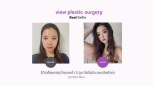 (รีวิว) ศัลยกรรมโครงหน้า 3 จุด ฉีดไขมัน และการเปิดหัวตา โรงพยาบาลวิว