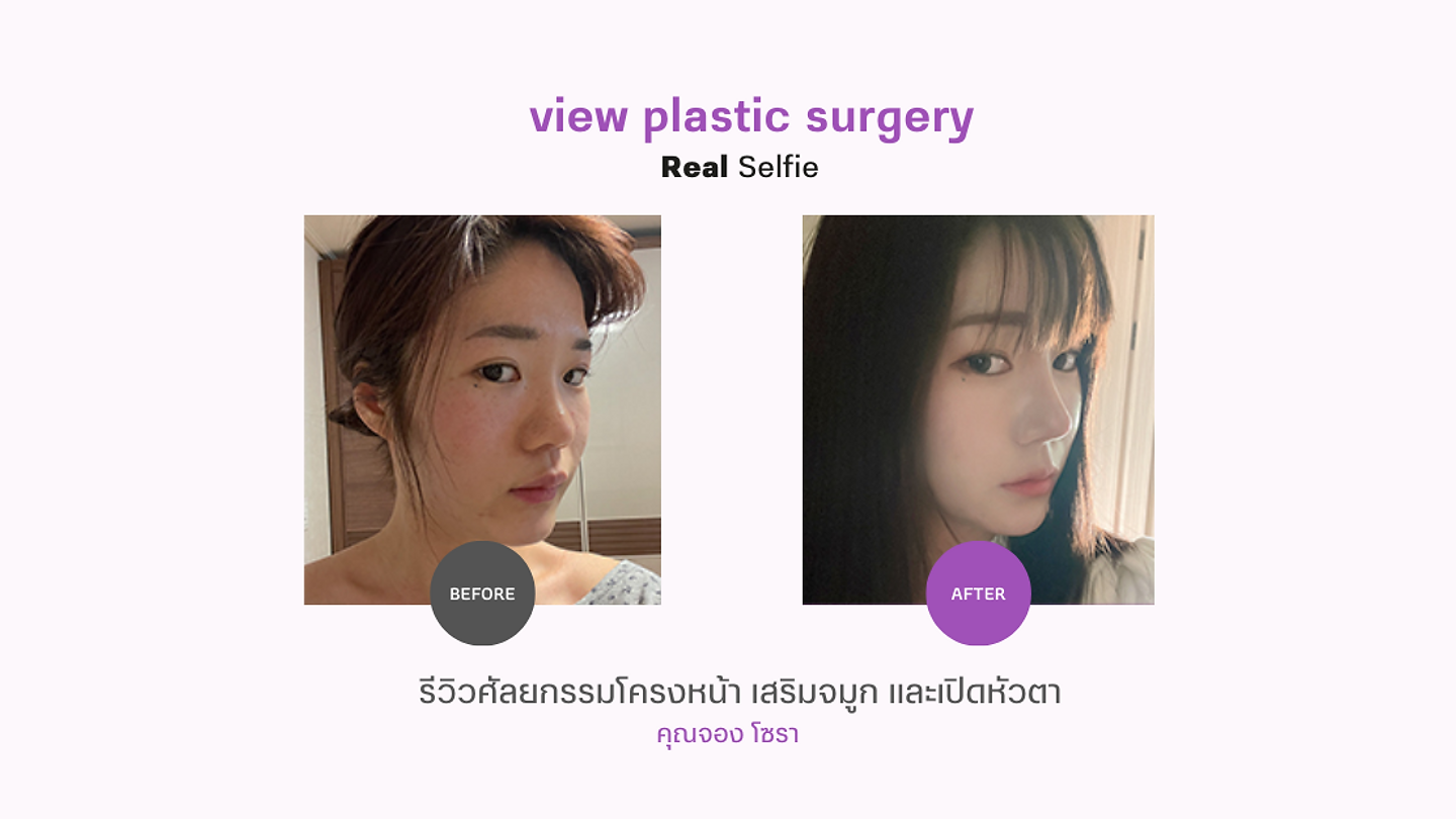 (รีวิว) ศัลยกรรมโครงหน้า เสริมจมูก และเปิดหัวตา โรงพยาบาลศัลยกรรมวิว (ตอนที่ 1)