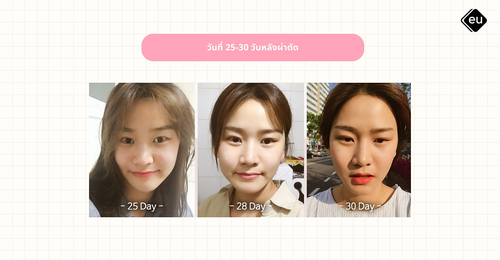 ภาพรีวิวหลังผ่าตัดศัลยกรรม