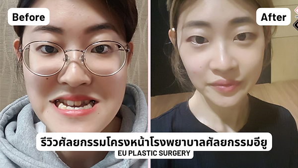 รีวิวศัลยกรรมโครงหน้าโรงพยาบาลศัลยกรรมอียู (EU Plastic Surgery)