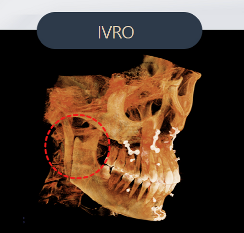 เทคนิคการผ่าตัดศัลยกรรม IVRO
