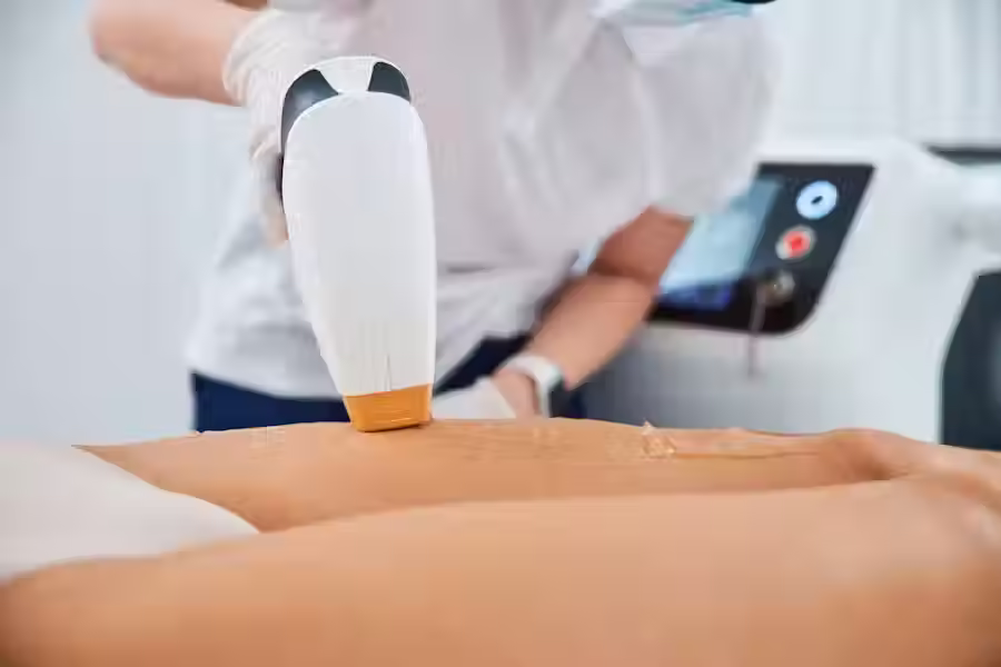 Laser hair removal – a smart and long-term solution to unwanted hair