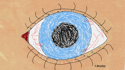 Staphylococcal Marginal Keratitis