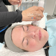 Hydro Facial results Essex