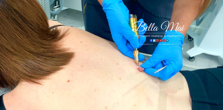 CryoPen skin tag removal before and after results Grays Essex