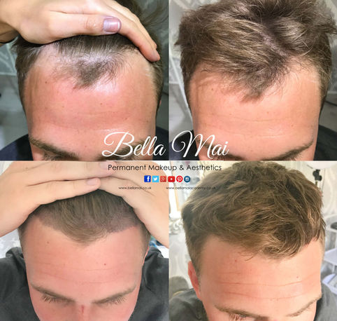 Scalp micropigmentation before and after hairline restoration Grays Essex
