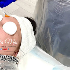 Chemical peel results for acne and scarring Grays Essex