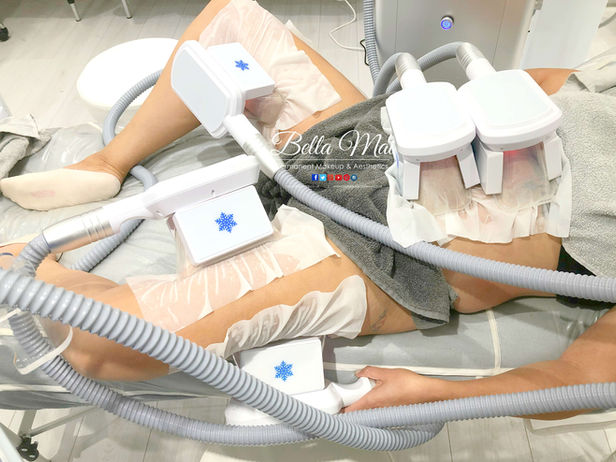 Cryolipolysis fat freezing on the abdomen, inside and outside of legs - Bella Mai Essex body contouring.