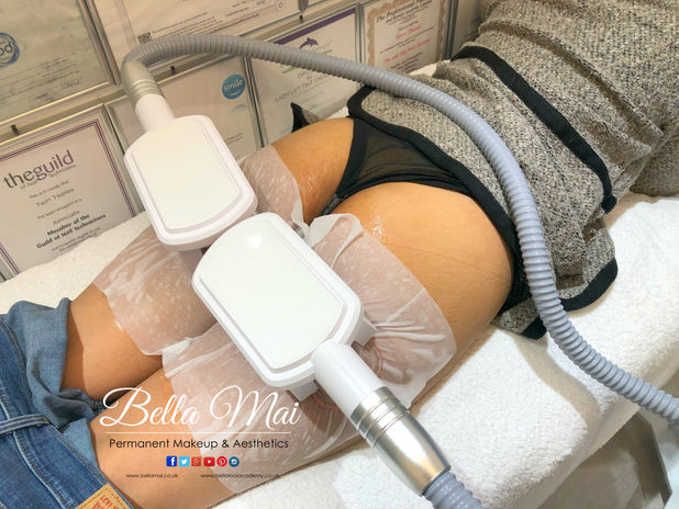 BBL skin tightening and fat removal results Grays