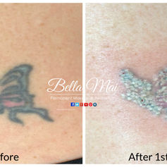 Laser tattoo removal before and after results Grays Essex
