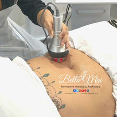 Stomach skin tightening after weight loss - RF treatment Grays