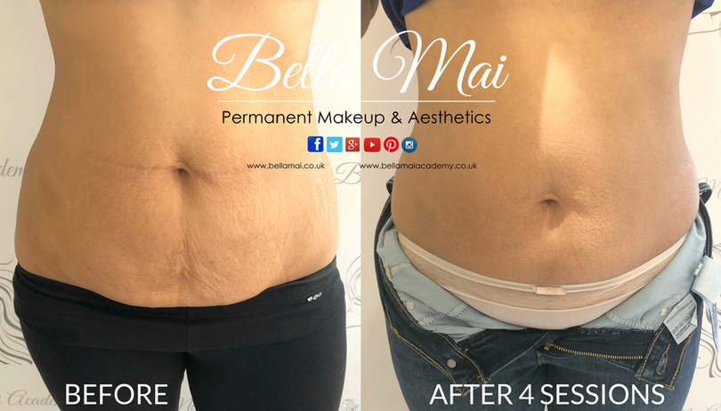 Stomach skin tightening after weight loss - RF treatment Grays