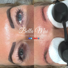 Laser removal of botched permanent makeup eyebrows and oxidized pigment before & after Grays