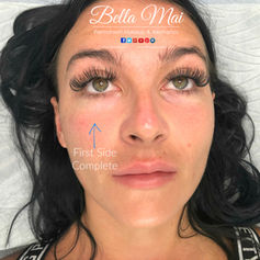 Tear Trough filler for dark circles Essex