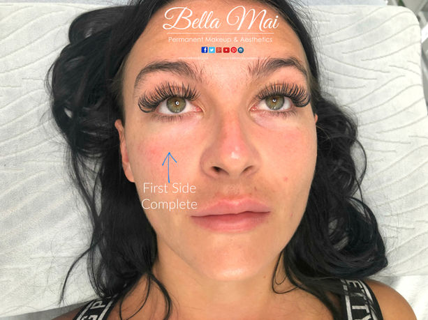 Tear Trough filler for dark circles Essex