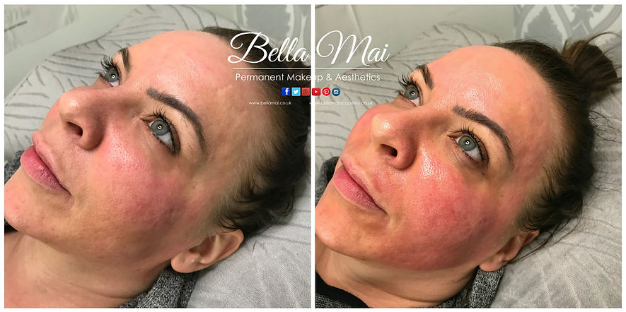 Microneedling results for fine lines and wrinkles Grays Essex