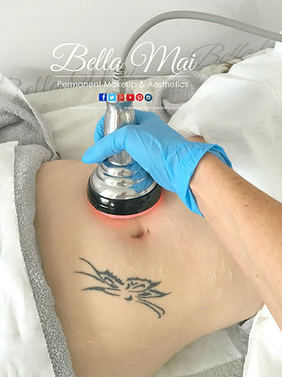 Ultrasound Cavitation fat reduction on abdomen - Bella Mai Essex body contouring.