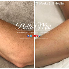 Paramedical micropigmentation for burn scars results Essex