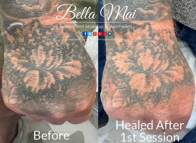Laser tattoo removal before and after results hand Grays Essex