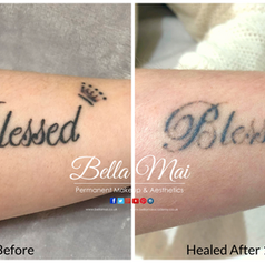 Laser tattoo removal before and after results Grays Essex