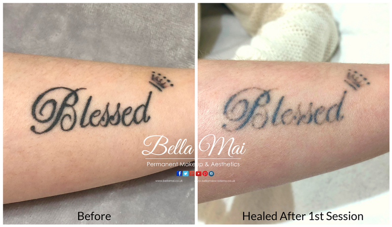 Laser tattoo removal before and after results Grays Essex