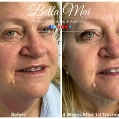 Profhilo BAP injection points for facial lifting Grays Essex