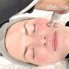 Hydro Facial results Essex