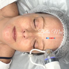 RF Microneedling before and after results Grays Essex