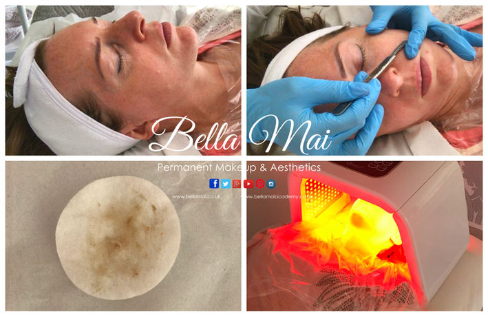 Dermaplaning results for glowing skin Grays