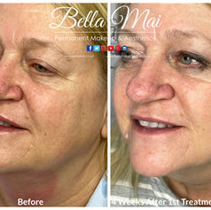 Profhilo BAP injection points for facial lifting Grays Essex