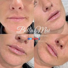 Natural lip filler Bella Mai Essex
