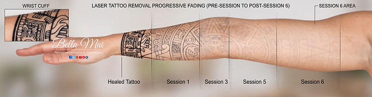 Laser tattoo removal before and after results Grays Essex