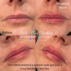 Foundation Dermal Filler Training in Thurrock, Essex. Bella Mai Academy