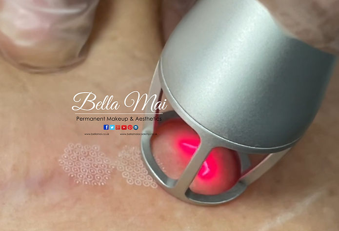 Fractional CO2 Laser Resurfacing