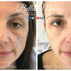 Tear Trough filler for dark circles Essex