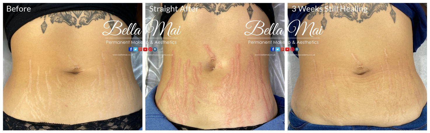 Medical Micropigmentation Stretch mark camouflage tattooing results stomach Grays Essex